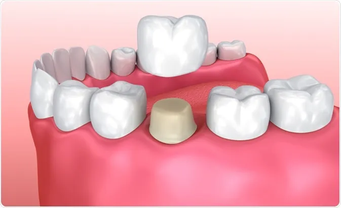 dentist crown