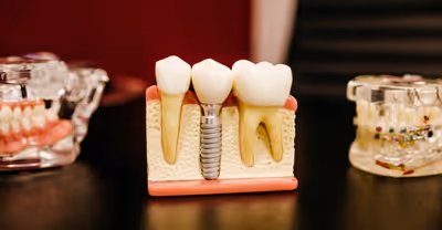 What Is Differences Between Crowns And Veneers?