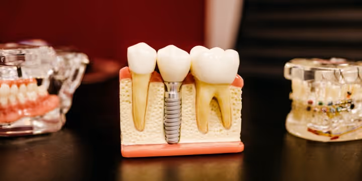 Understand Tooth Implant