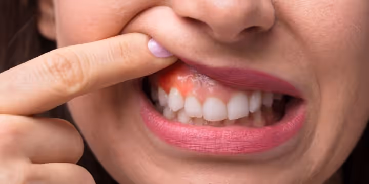 What is Gum contouring