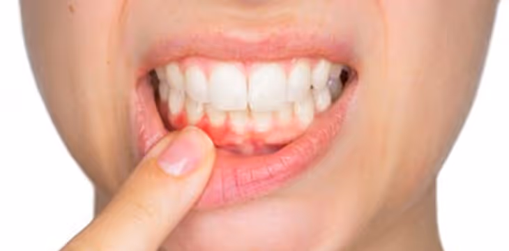 How to properly treat gum disease from diagnosis to treatment
