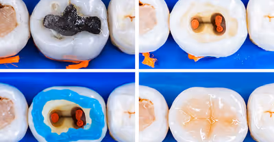 A step-by-step guide to root canal treatment