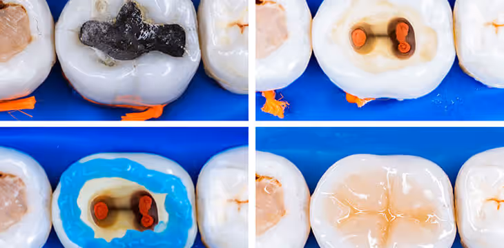 A step-by-step guide to root canal treatment