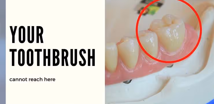 Why You Should Do Regular Check Up For Teeth?