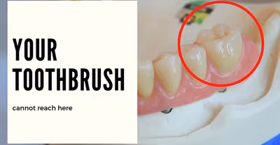 Why You Should Do Regular Check Up For Teeth?
