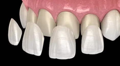 dentist veneer
