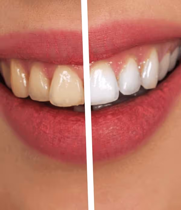 whitening