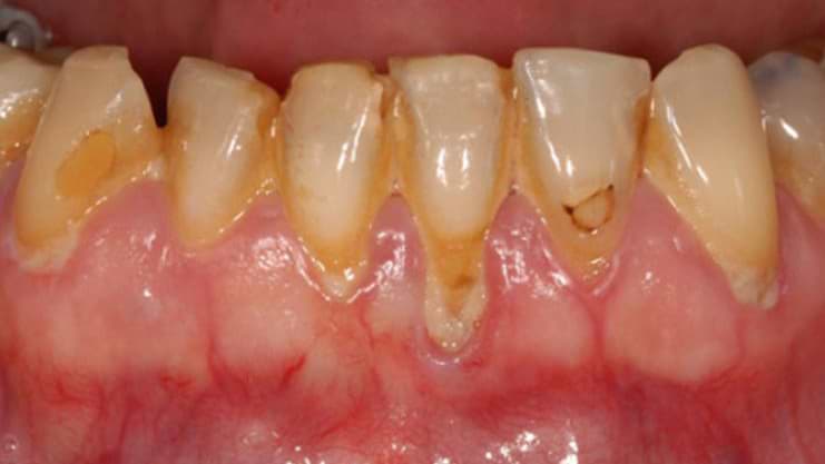Dentist Bukit Jalil gum disease